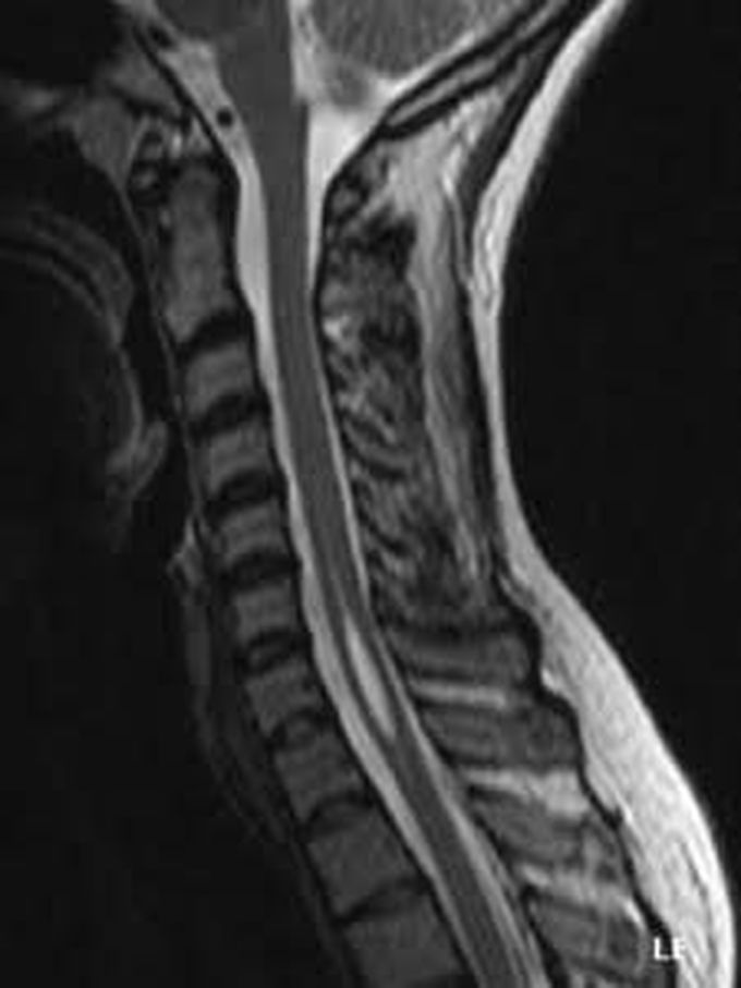 Syringomyelia