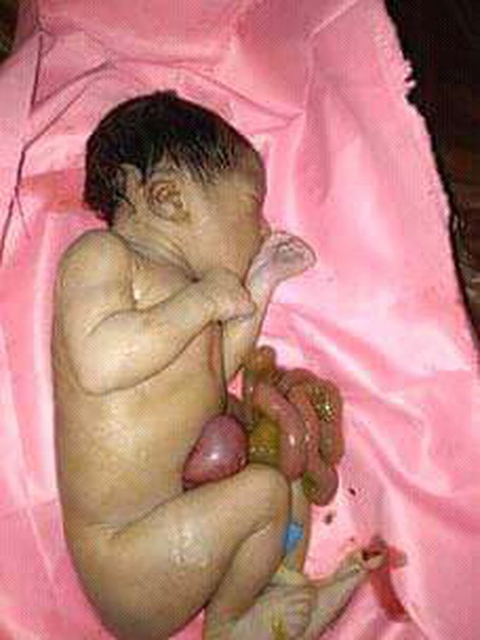 He was born but the intestine is out of stomach.