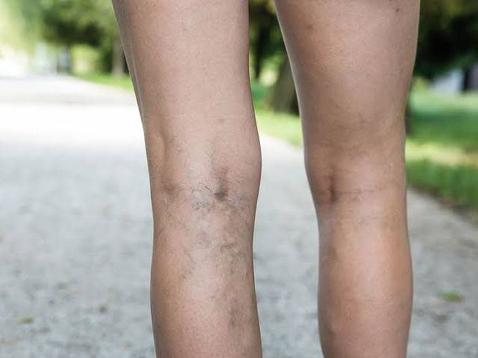 Symptoms of varicose veins