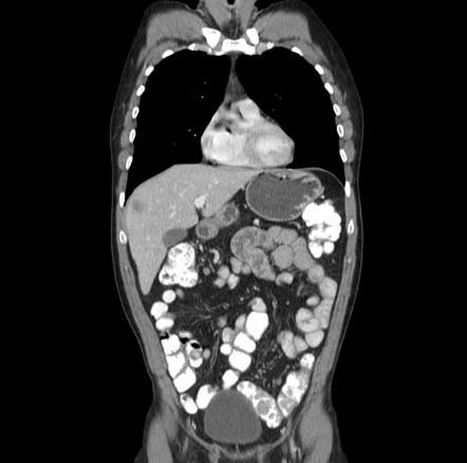 Turcot Syndrome