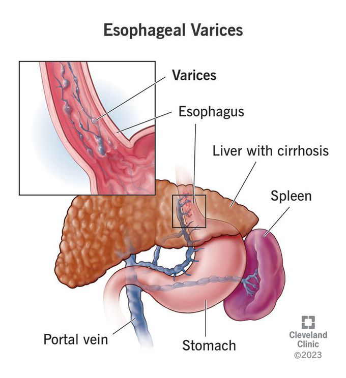 Causes of esophageal varices