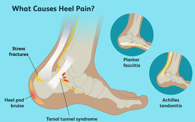 These are the causes of heel pain