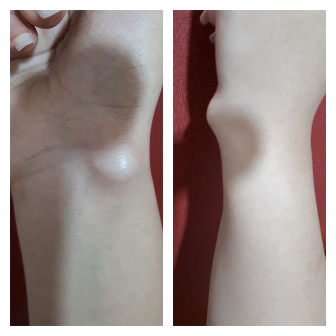 Tendonitis