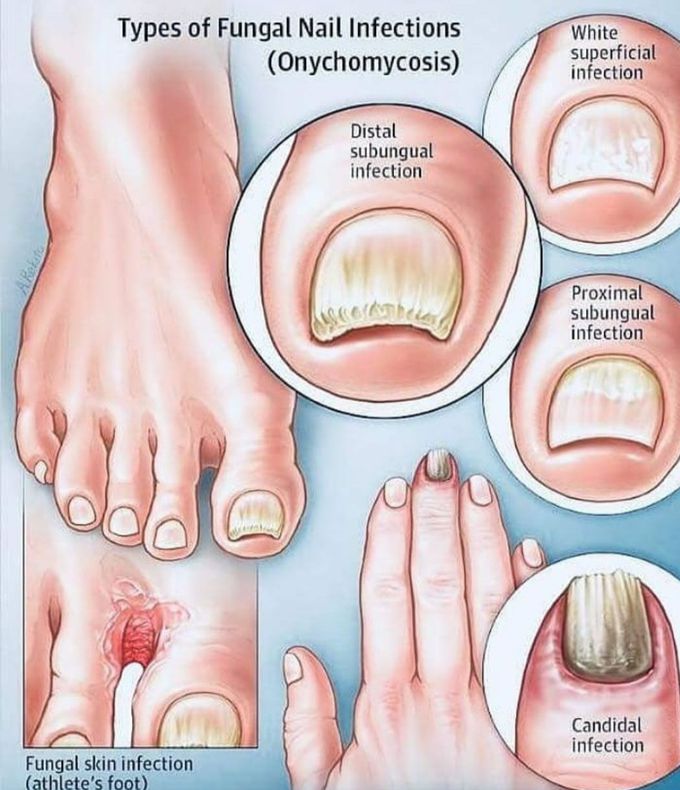 Fungal infections