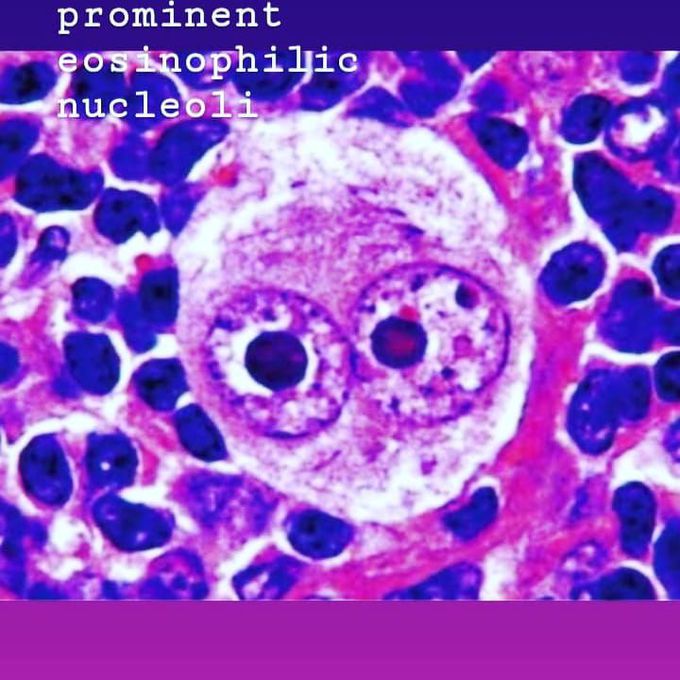 RS cell (owl eye appearence )
