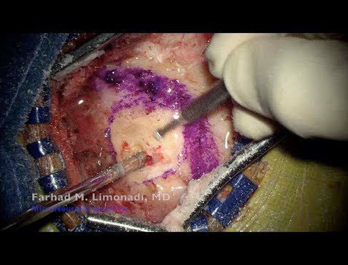 MVD (microvascular decompression) of facial nerve for treatment of hemifacial spasm