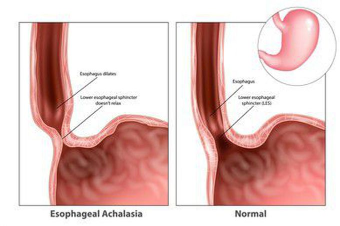 Achalasia