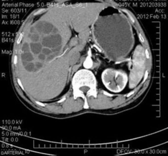 Daughter Cysts In Hydatid Cyst Medizzy