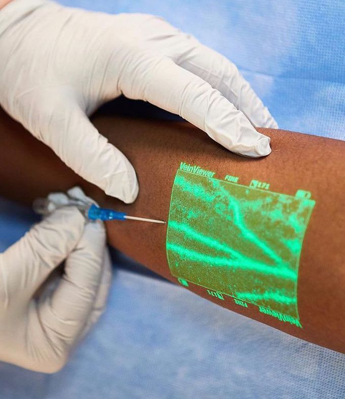 Vein finder assisting in IV cannulation