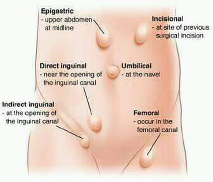 Frequent types of hernia