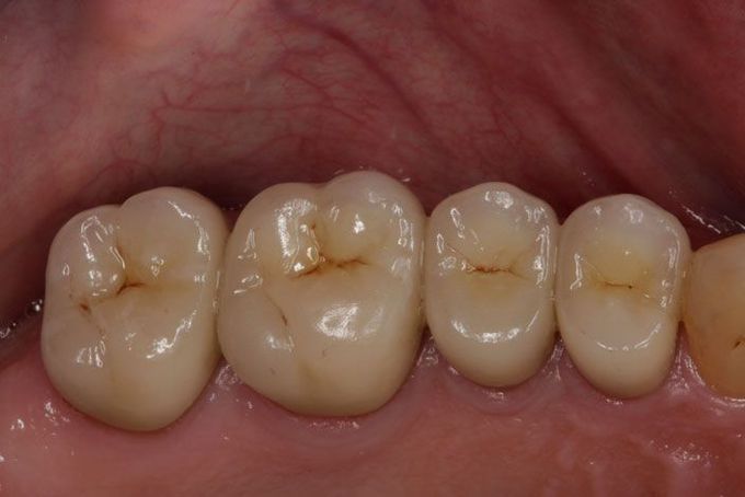 What are posterior teeth?