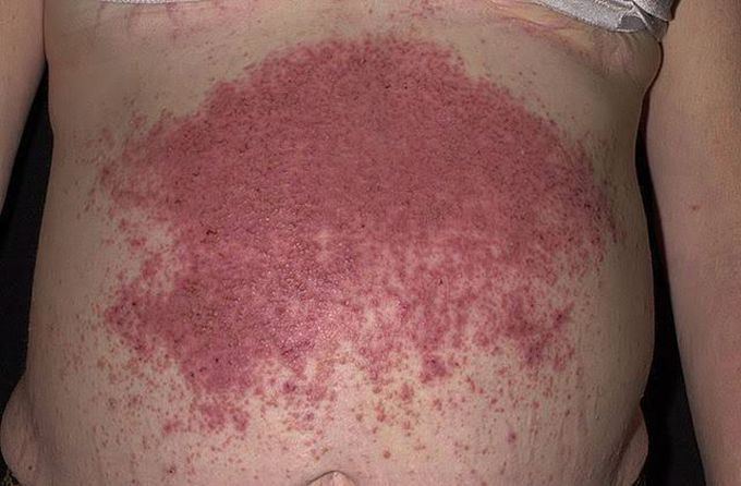 Dermatitis Herpetiform