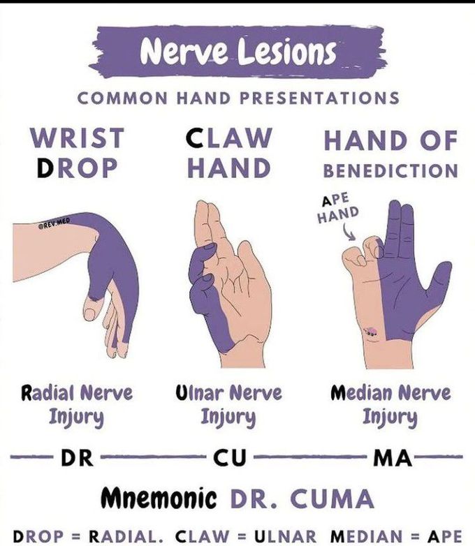 Nerve lesions
