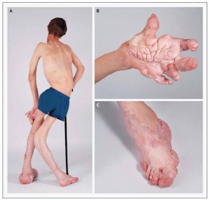 Proteus syndrome
