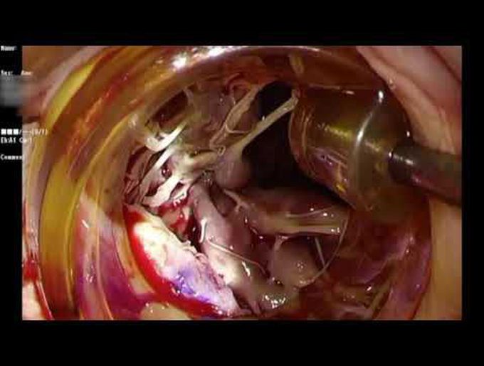 A Novel and Versatile Tool for Mitral Valve Repair: The Memo 4D System