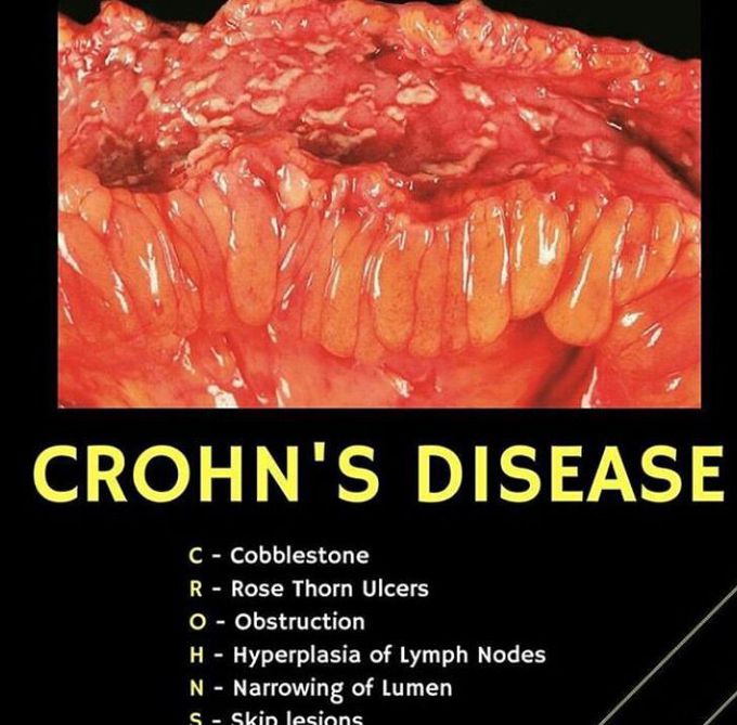 Crohn’s disease mnemonic