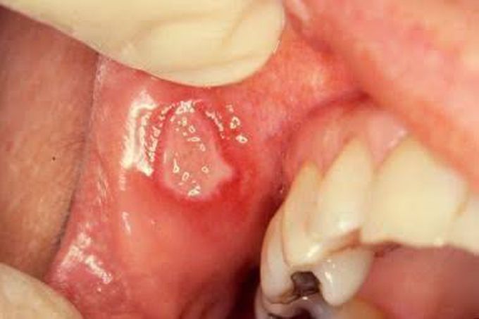 Major Aphthous Ulcer