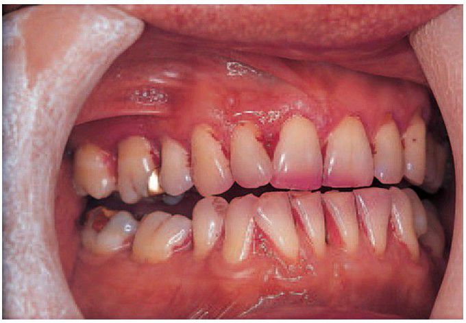 The effects of tooth brushing in the same patient.