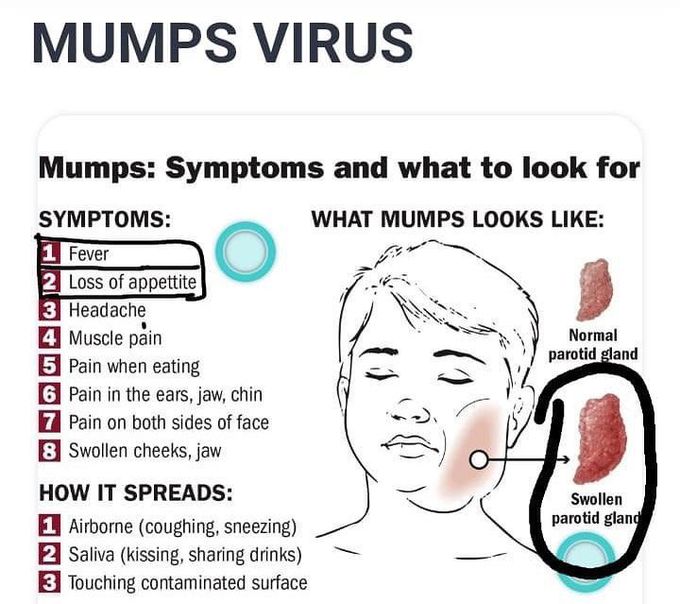 Mumps