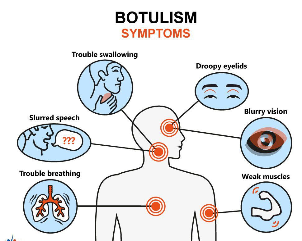 botulism symptoms