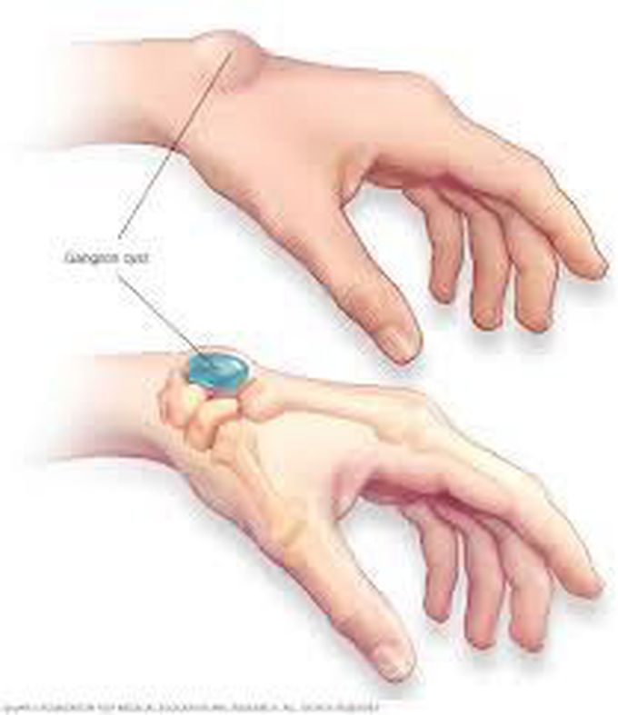 Ganglion