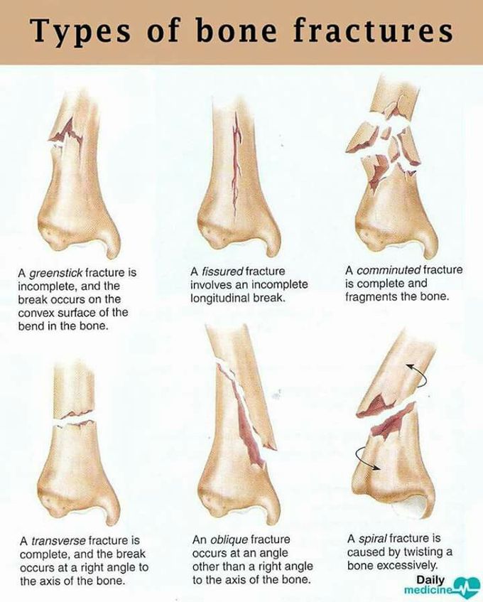 Types of Fractures