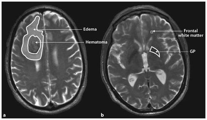 Representative picture of hematoma and perihematoma.......,................