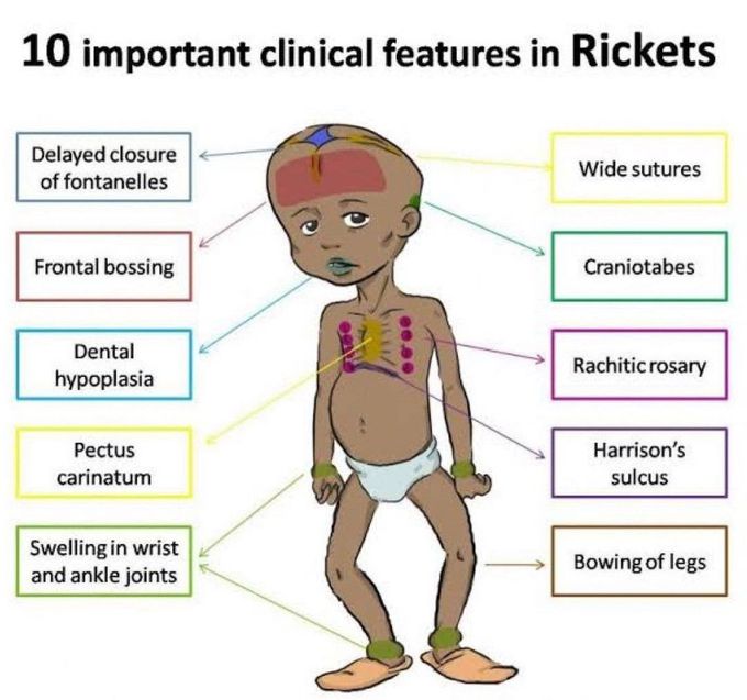 Rickets - Clinical Features