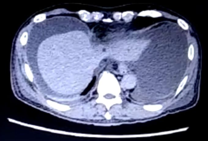 Liver CT scan