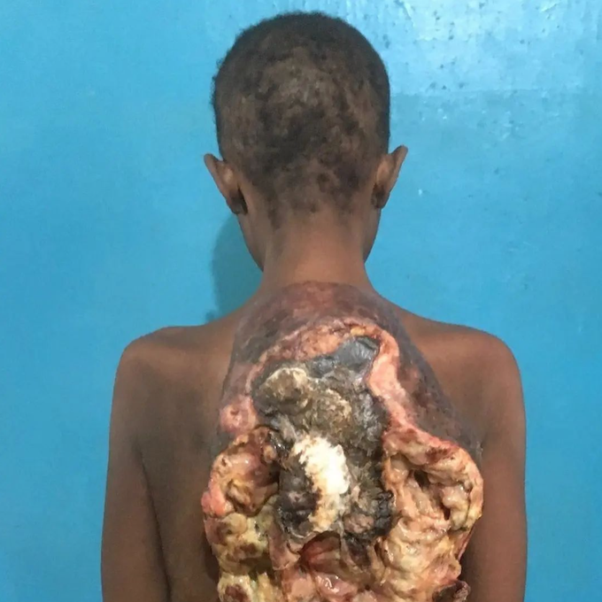 A case of a young woman with a Necrotic Sarcoma of the back.