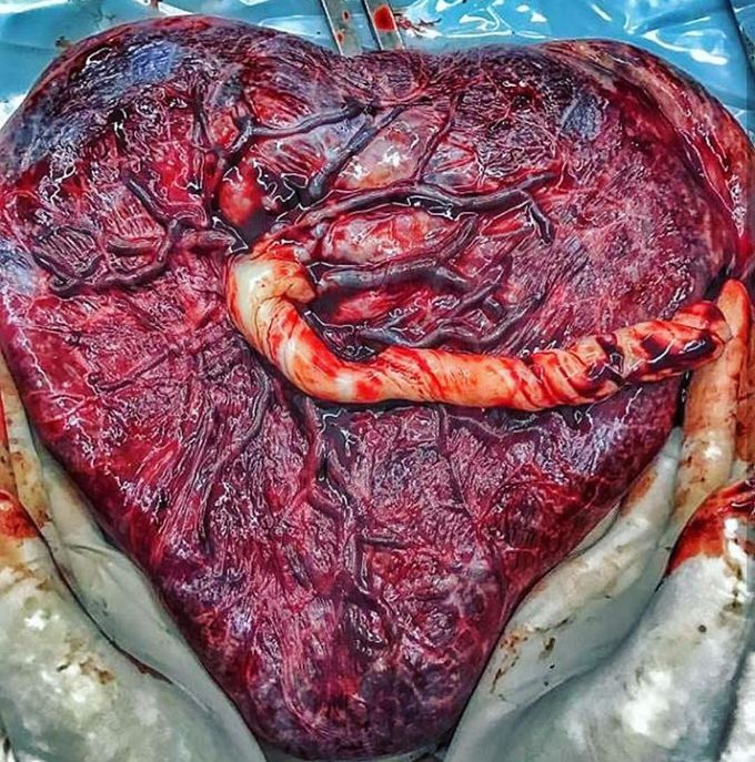Human placenta, the source of life 