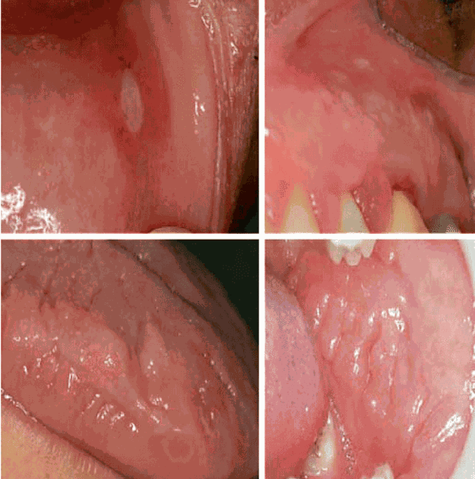 Aphthous stomatitis in the course of Crohn’s disease. 