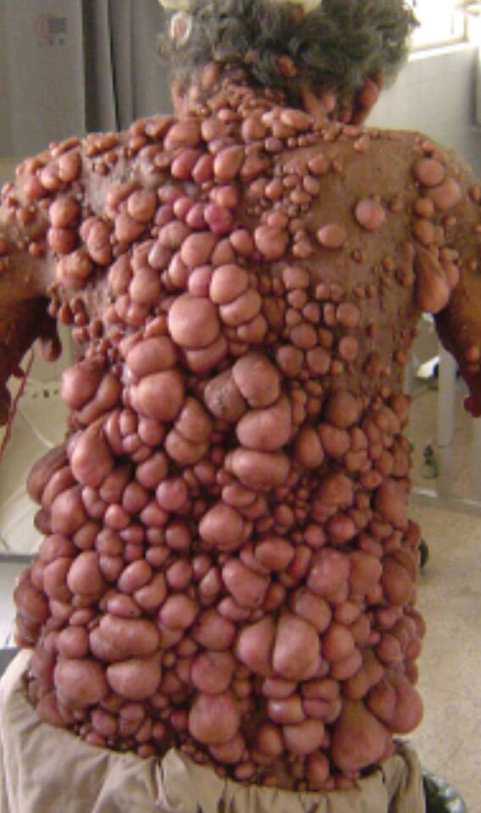 Neurofibromatosis