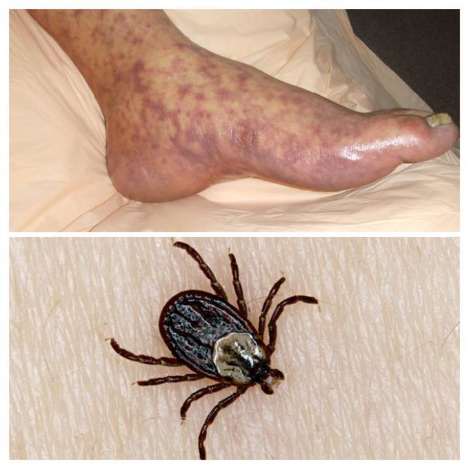 Rocky Mountain Spotted Fever