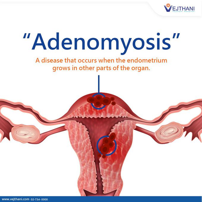 What is adenomyosis?