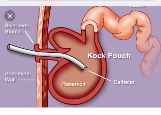 Ever heard of a Kock pouch also known as a continent ileostomy