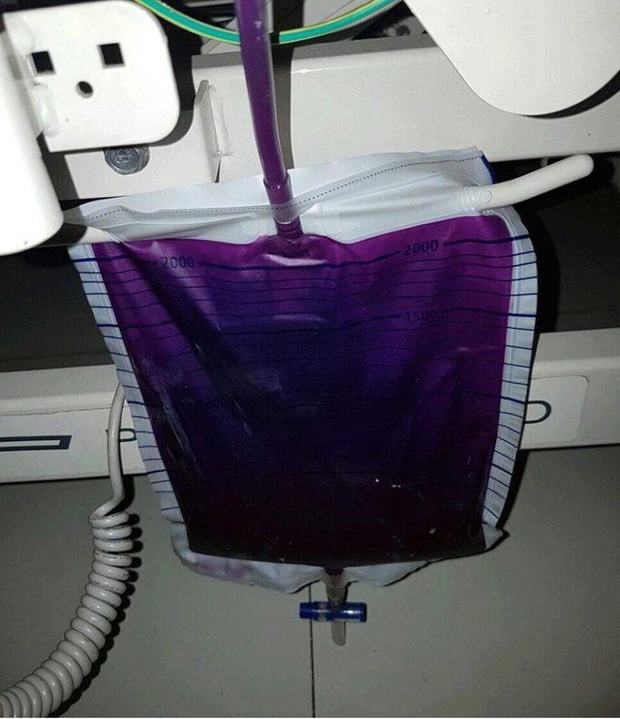 Purple Urine