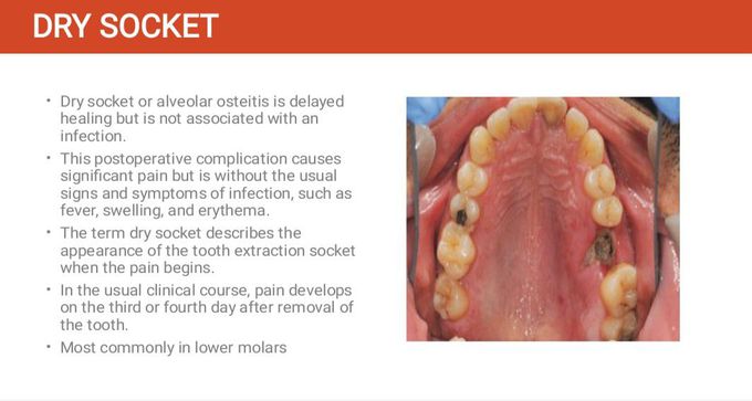 Dry Socket