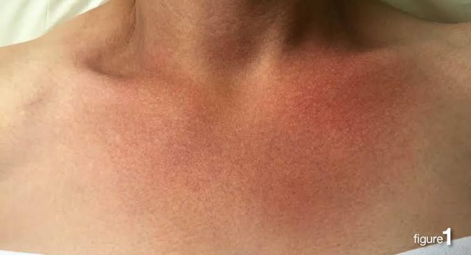 Symptoms of carcinoid tumor