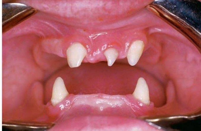 Ectodermal dysplasia