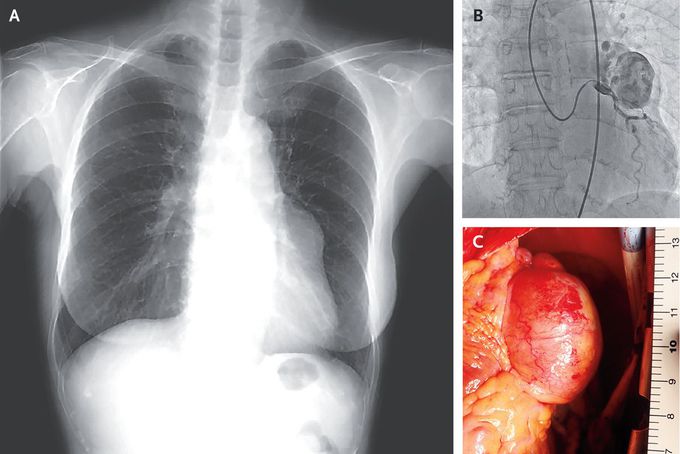 Giant Coronary-Artery Aneurysm