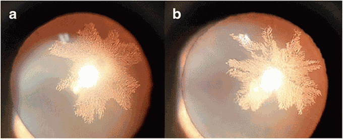 Bilateral Snowflake Cataract - A Case Report