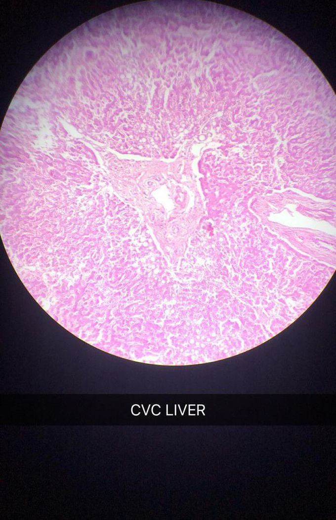 Chronic venous congestion of liver