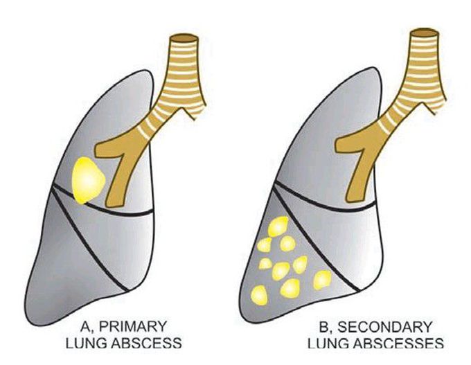 Common locations of lung abscess.