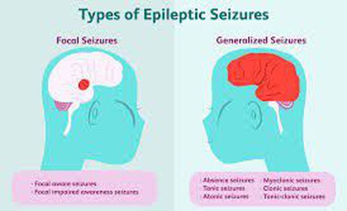 Types Of Epileptic Seizures - MEDizzy