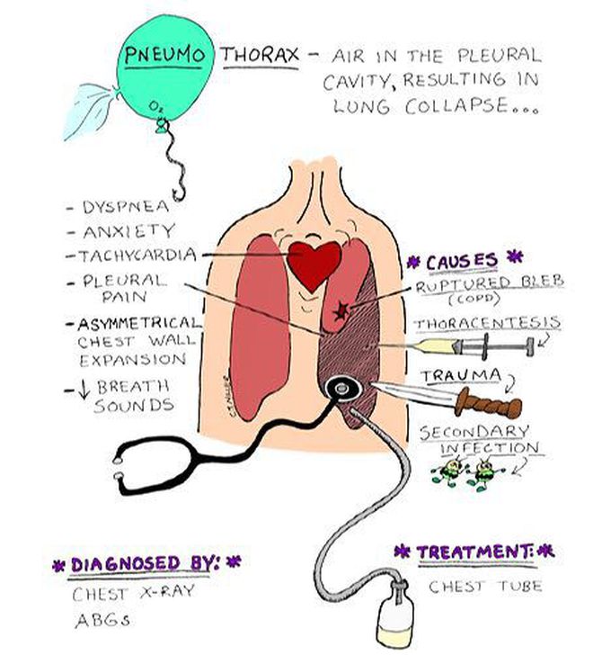 Pneumothorax