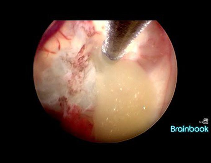 The colloid cyst