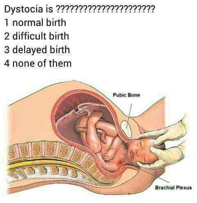 Dystocia is....