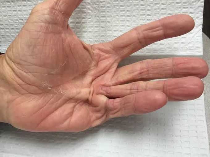 Dupuytren's contracture symptoms