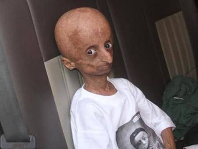 Progeria